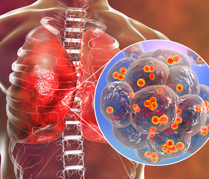 An illustration of lungs with a close-up of cancerous cells in the body.