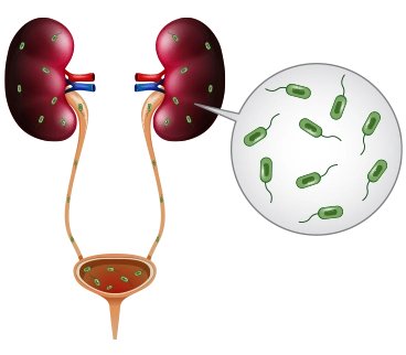 An illustration of the human urinary system with bacteria infecting the kidneys and urinary tract.